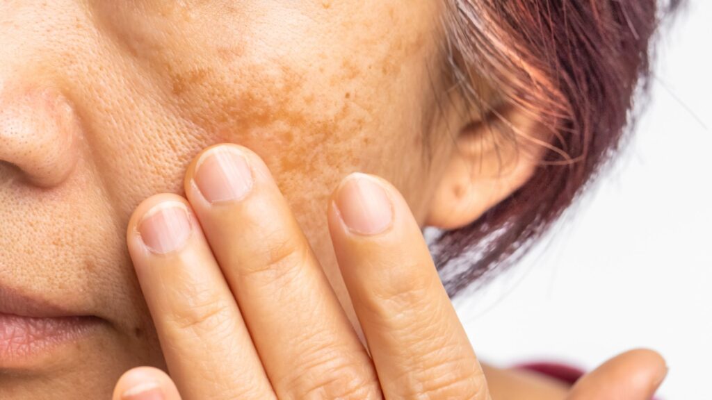 Why hyperpigmentation doesn’t improve even when you use the right ingredients